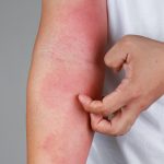 person itching red rash on inner arm