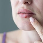Women with cold sore on lip