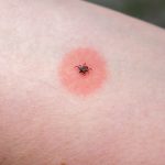 Tick on skin with red discoloration around it