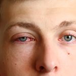 Man with a swollen bloodshot eye